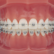Что стоит за красивой улыбкой: влияние ортодонтии на здоровье организма